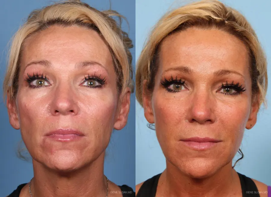 Fat Transfer - Face: Patient 1 - Before and After 1