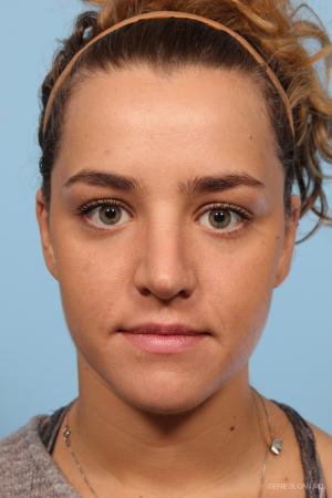 Rhinoplasty: Patient 9 - After Image 1