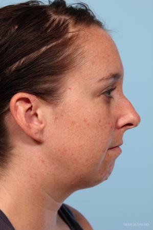 Rhinoplasty: Patient 4 - Before and After Image 2