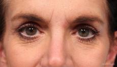 Blepharoplasty: Patient 2 - After Image