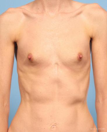 Breast Augmentation: Patient 9 - Before Image 1