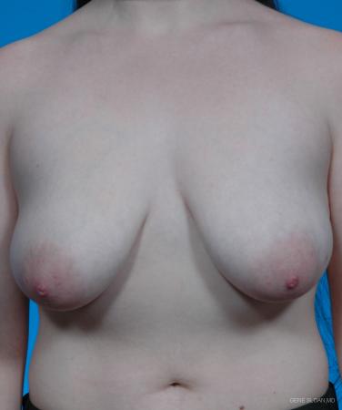 Breast Lift: Patient 3 - Before Image 1