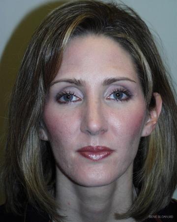 Rhinoplasty: Patient 1 - After Image 1