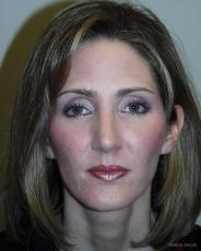 Rhinoplasty: Patient 1 - After Image