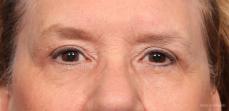 Blepharoplasty: Patient 3 - After Image