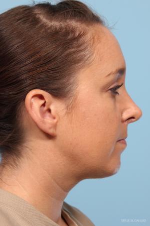 Rhinoplasty: Patient 4 - After Image 2