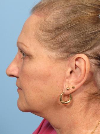 Facelift: Patient 6 - After Image 2