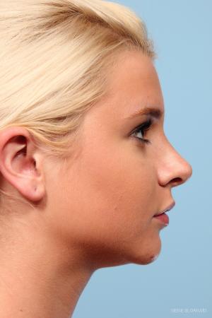 Rhinoplasty: Patient 8 - After Image 2