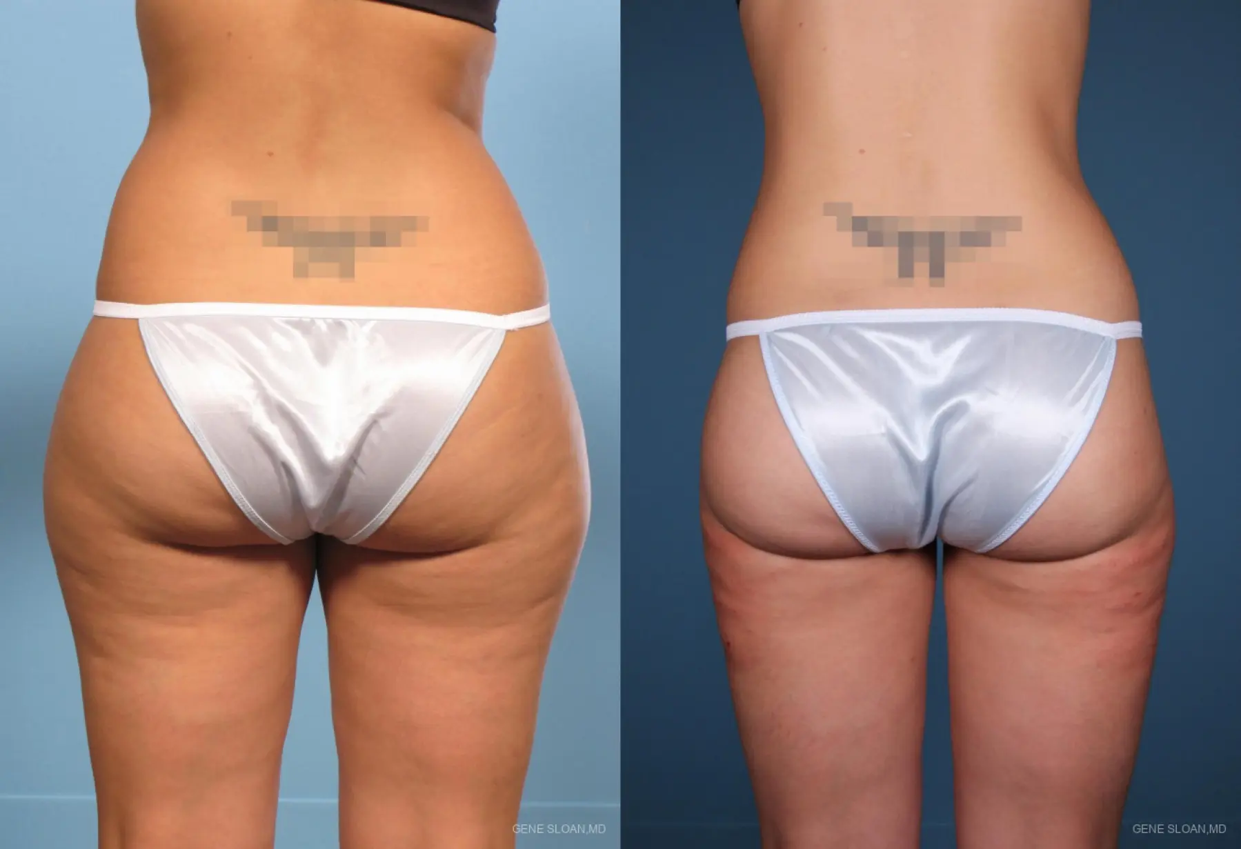 Liposuction: Patient 1 - Before and After 2