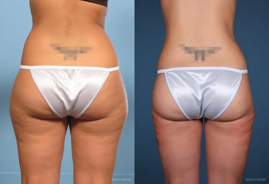Liposuction: Patient 1 - Before and After 2