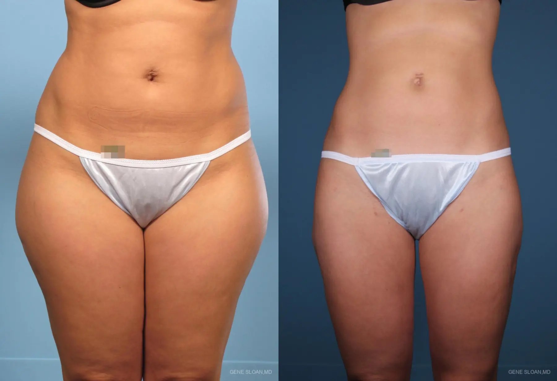 Liposuction: Patient 1 - Before and After 1