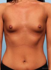 Breast Augmentation: Patient 6 - Before Image
