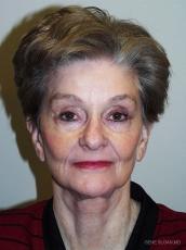 Facelift: Patient 3 - After Image