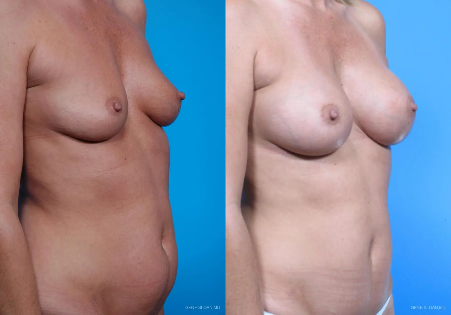 Mommy Makeover: Patient 1 - Before and After 2