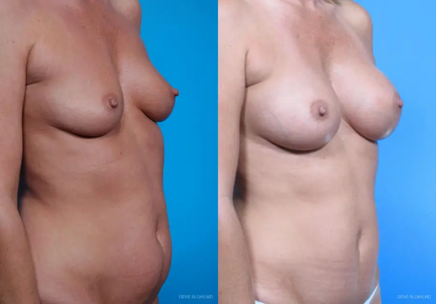 Mommy Makeover: Patient 1 - Before and After 2
