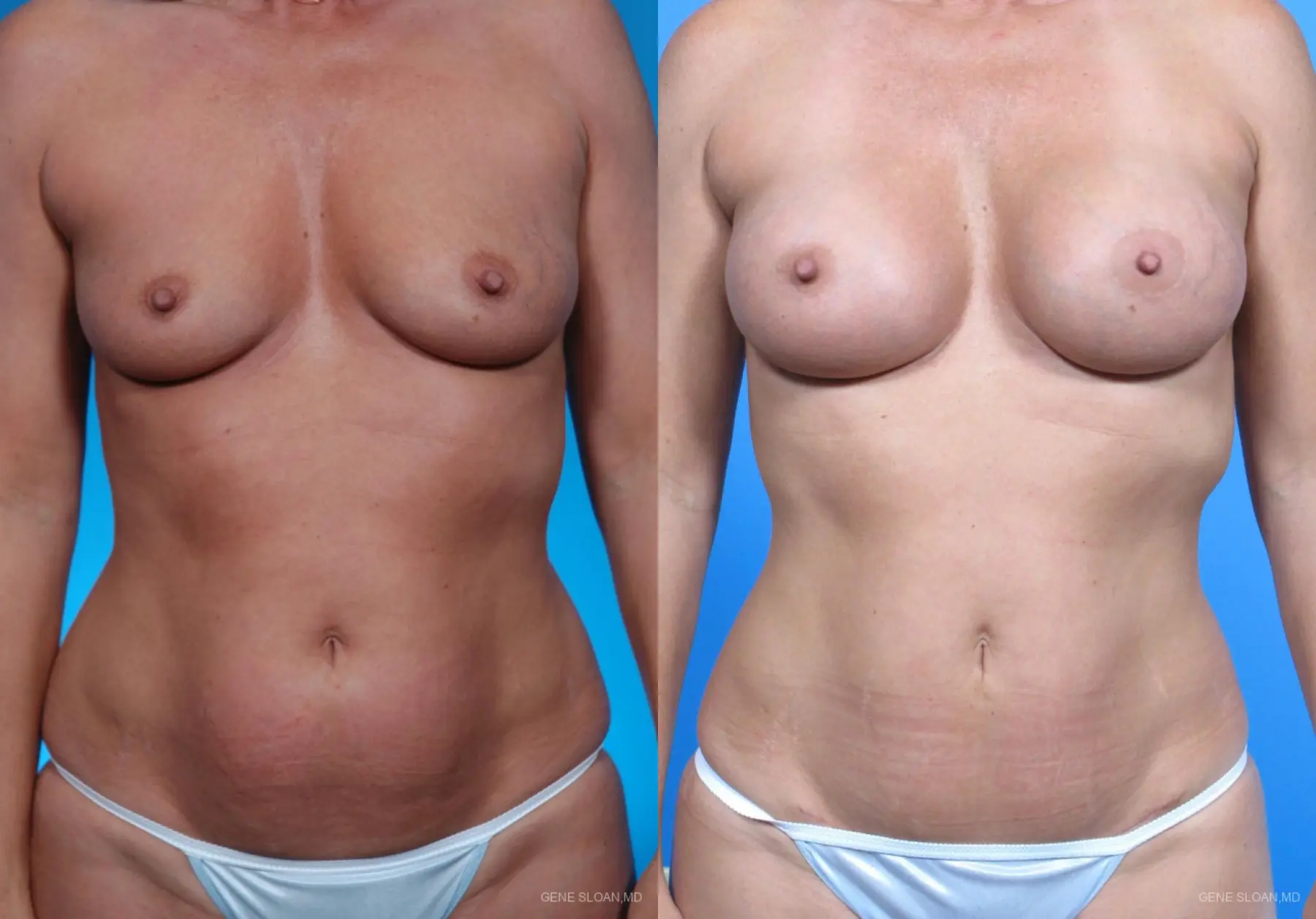 Mommy Makeover: Patient 1 - Before and After 1