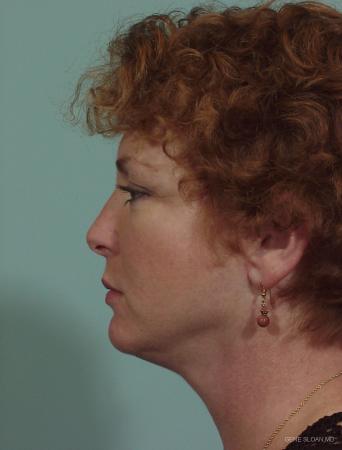 Neck Lift: Patient 1 - After Image 2