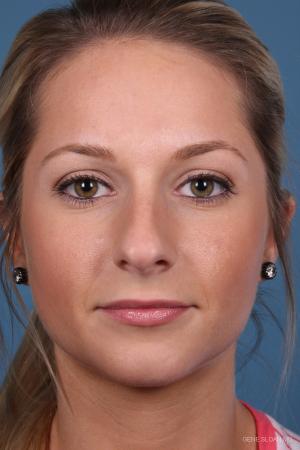 Rhinoplasty: Patient 7 - Before Image 1