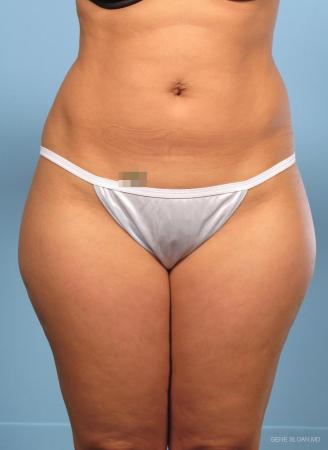 Liposuction: Patient 1 - Before Image 1