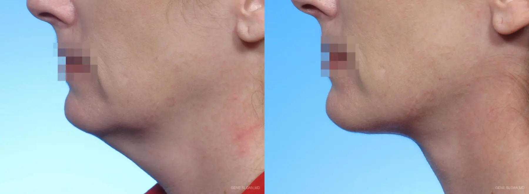 Neck Lift: Patient 2 - Before and After  