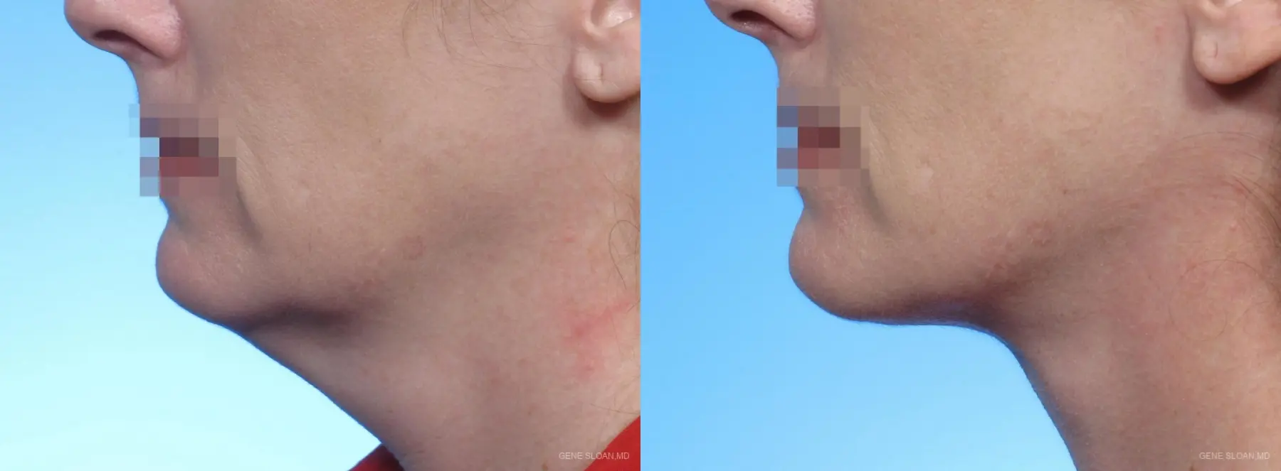 Neck Lift: Patient 2 - Before and After 1