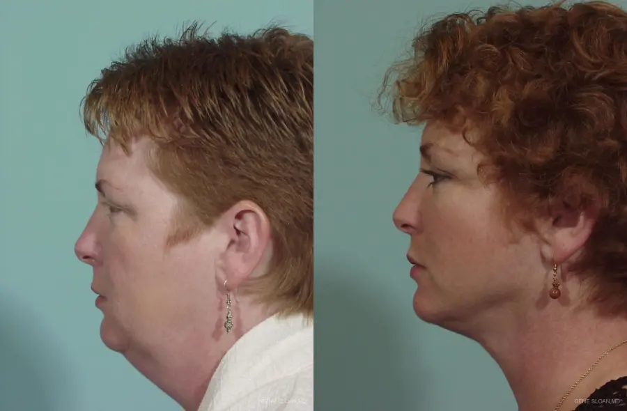 Neck Lift: Patient 1 - Before and After 2