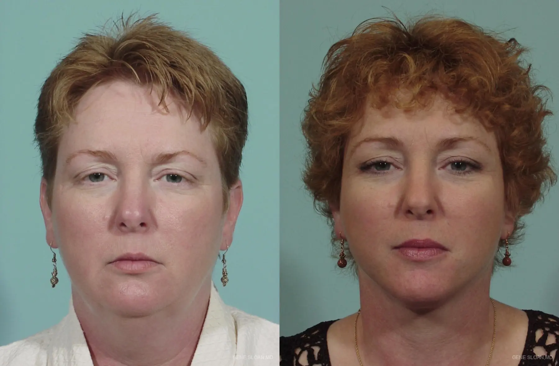 Neck Lift: Patient 1 - Before and After 1