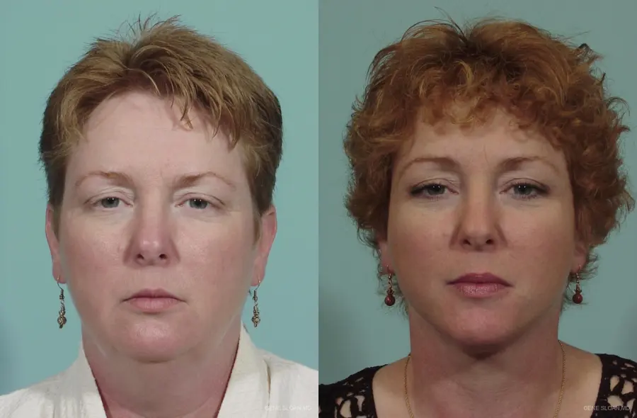 Neck Lift: Patient 1 - Before and After 1