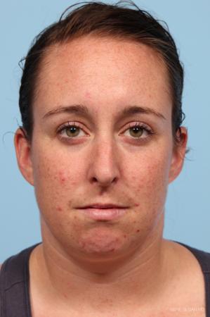 Rhinoplasty: Patient 4 - Before Image 1