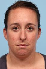 Rhinoplasty: Patient 4 - Before Image
