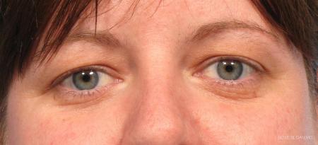 Blepharoplasty: Patient 5 - Before Image 1