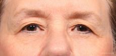 Blepharoplasty: Patient 3 - Before Image