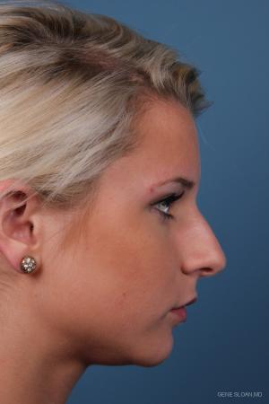 Rhinoplasty: Patient 8 - Before and After Image 2