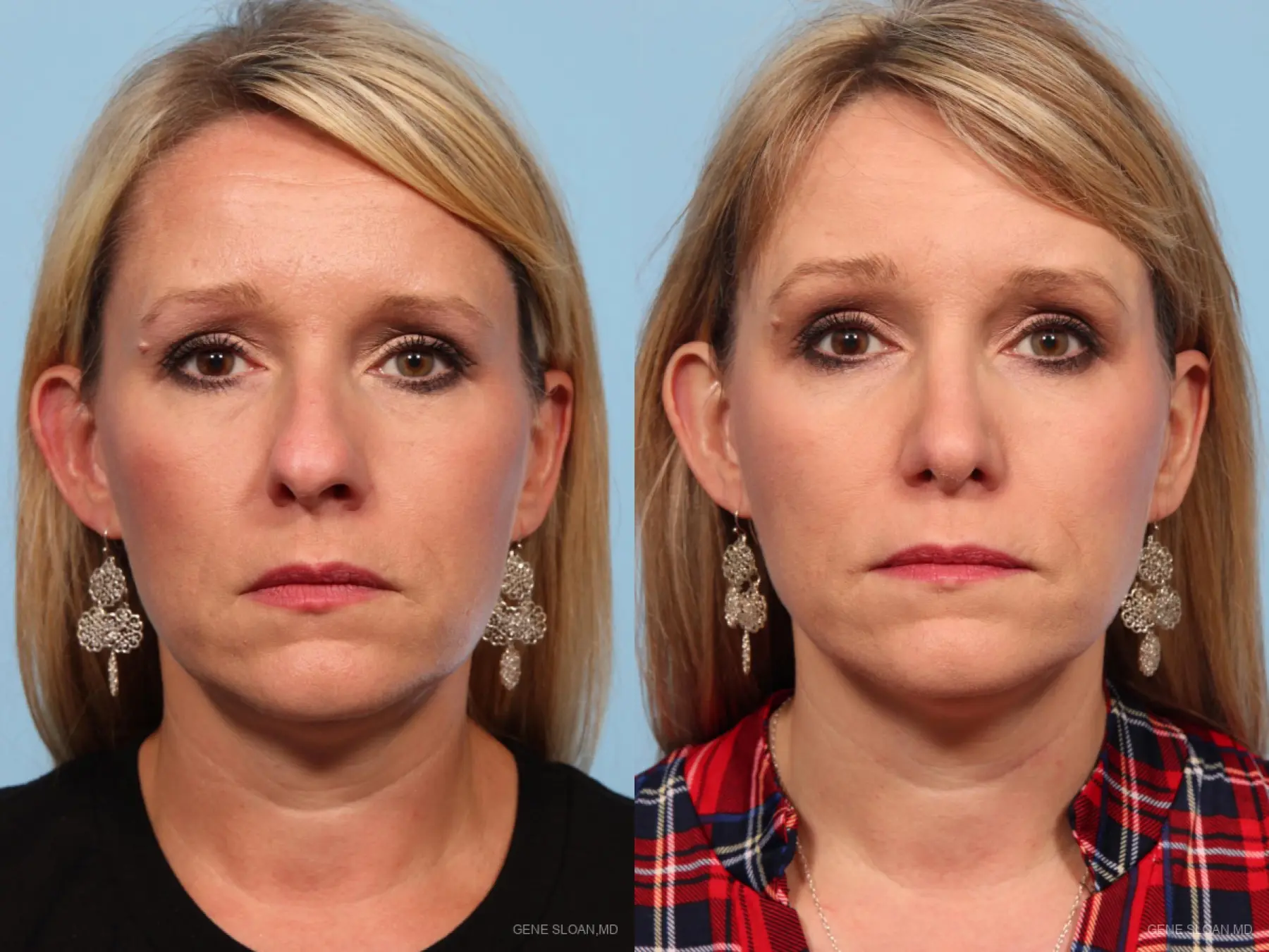 Rhinoplasty: Patient 3 - Before and After