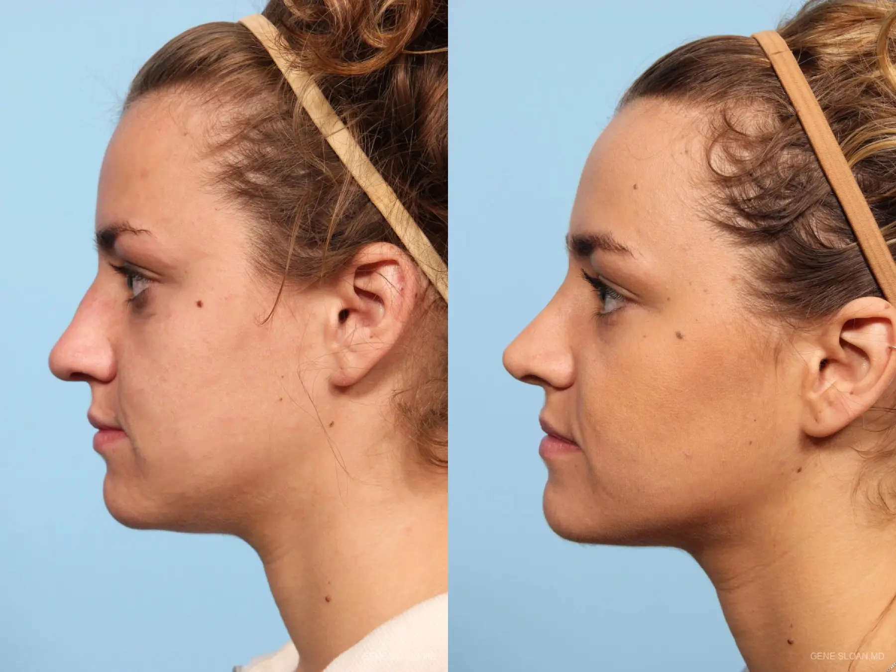 Rhinoplasty: Patient 9 - Before and After 2