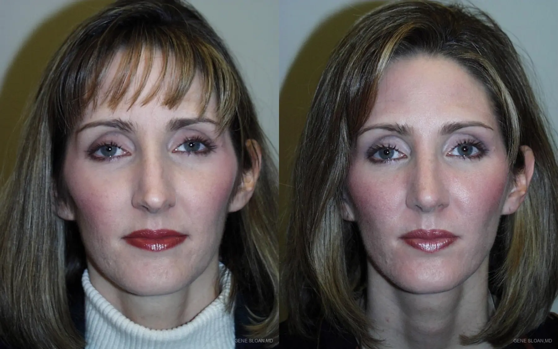 Rhinoplasty: Patient 1 - Before and After