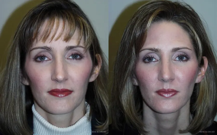 Rhinoplasty: Patient 1 - Before and After  