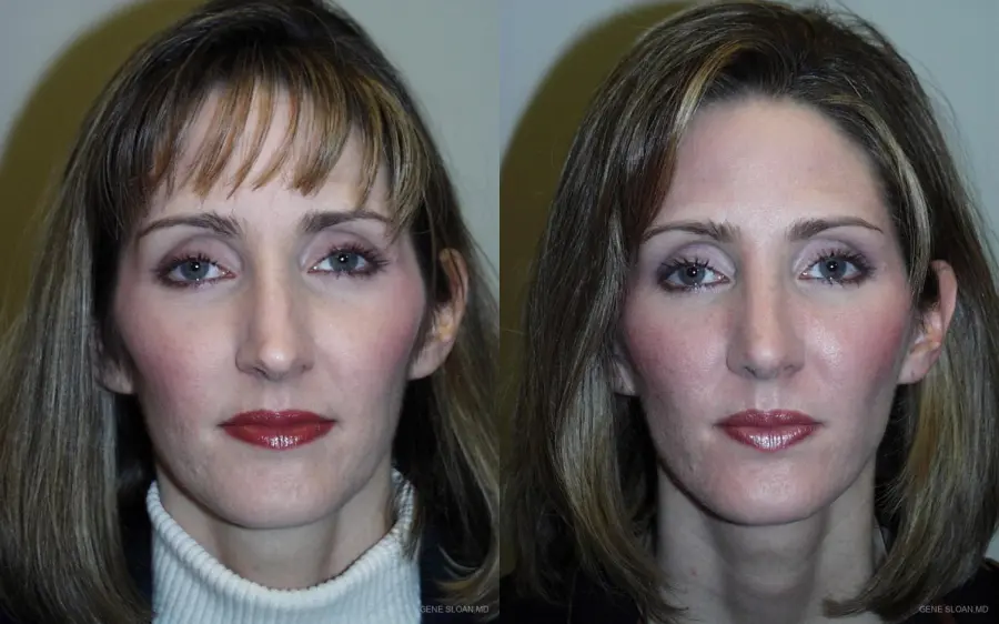 Rhinoplasty: Patient 1 - Before and After 1