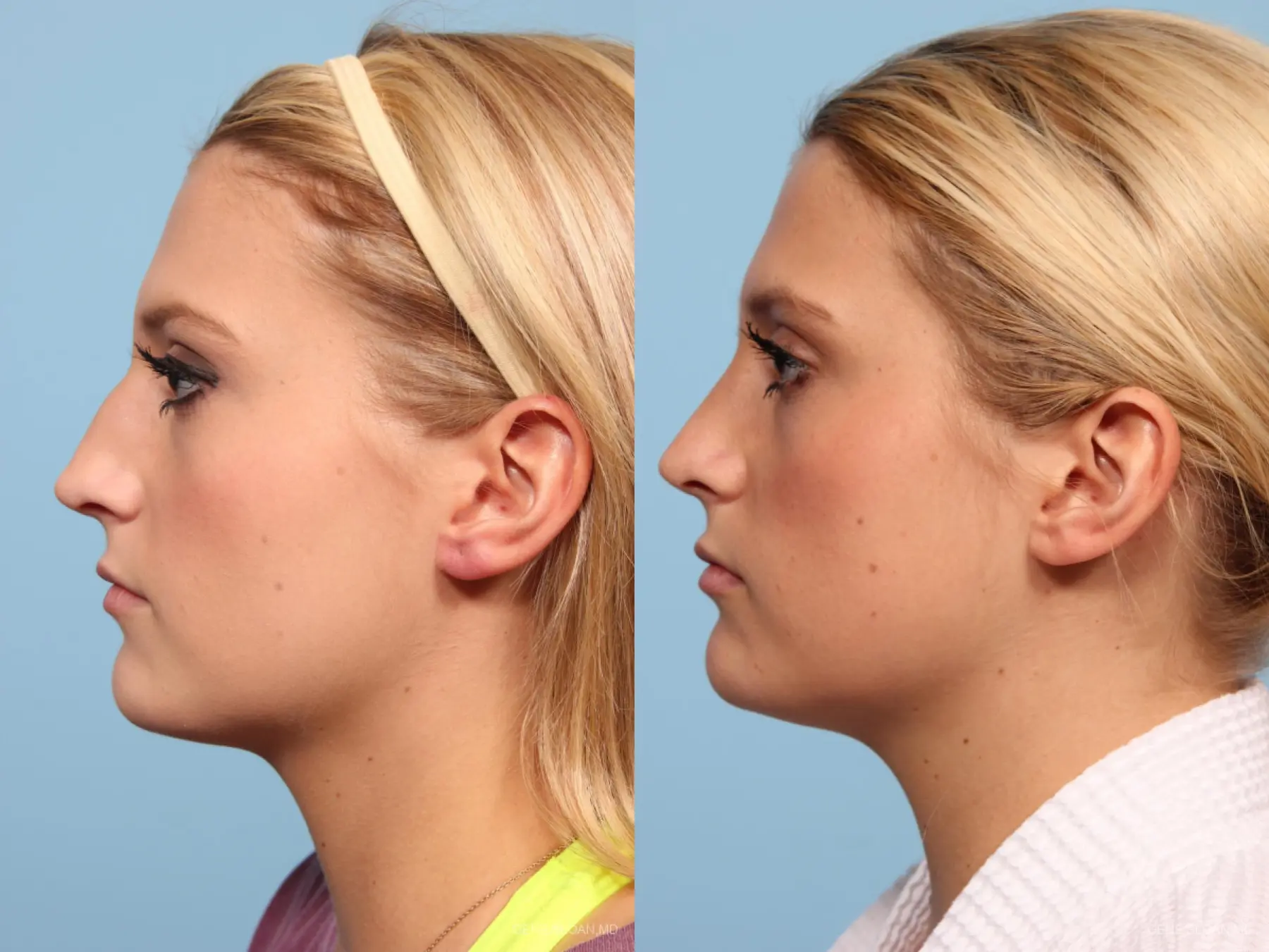 Rhinoplasty: Patient 6 - Before and After 2