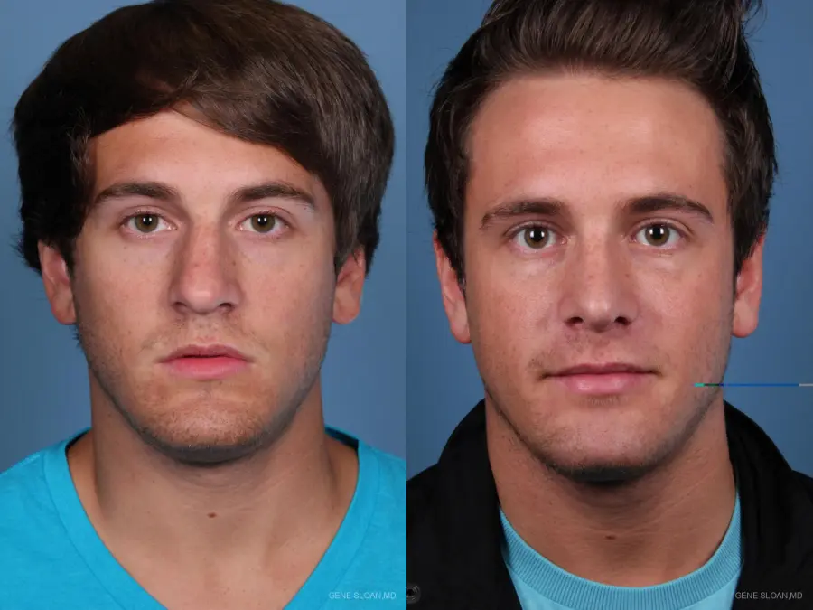 Rhinoplasty: Patient 5 - Before and After 1