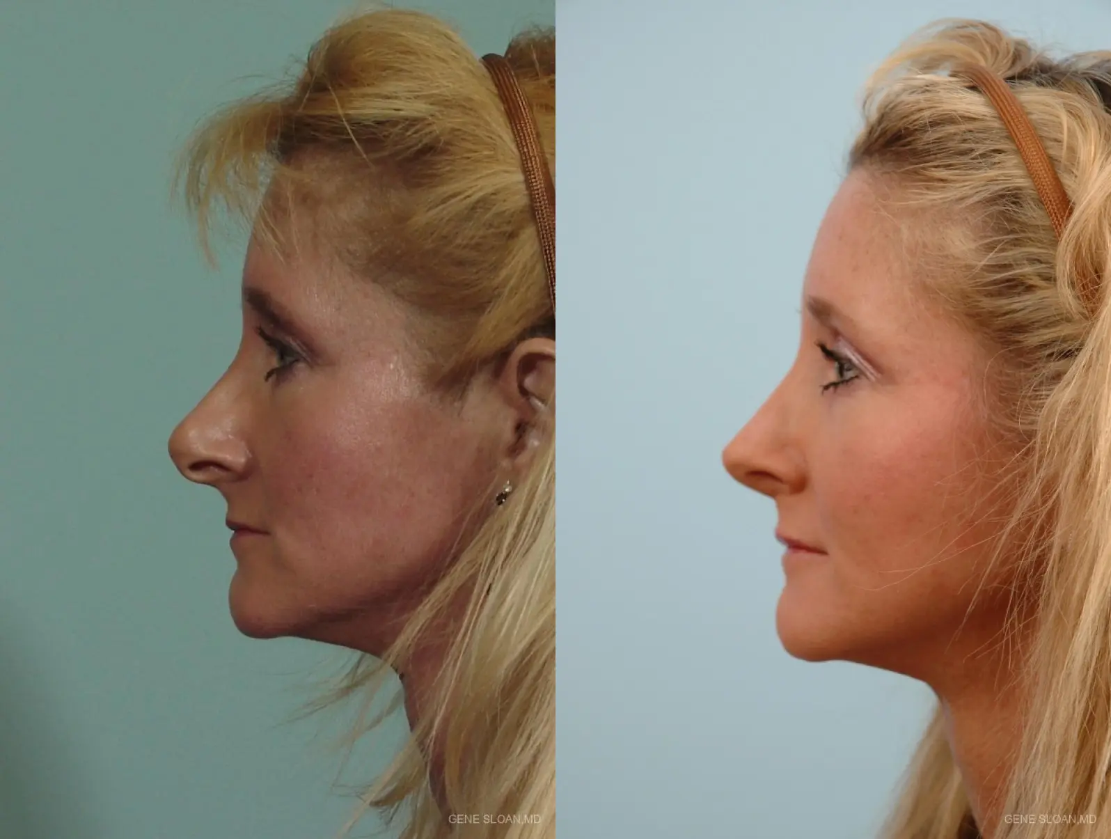 Rhinoplasty: Patient 2 - Before and After 2