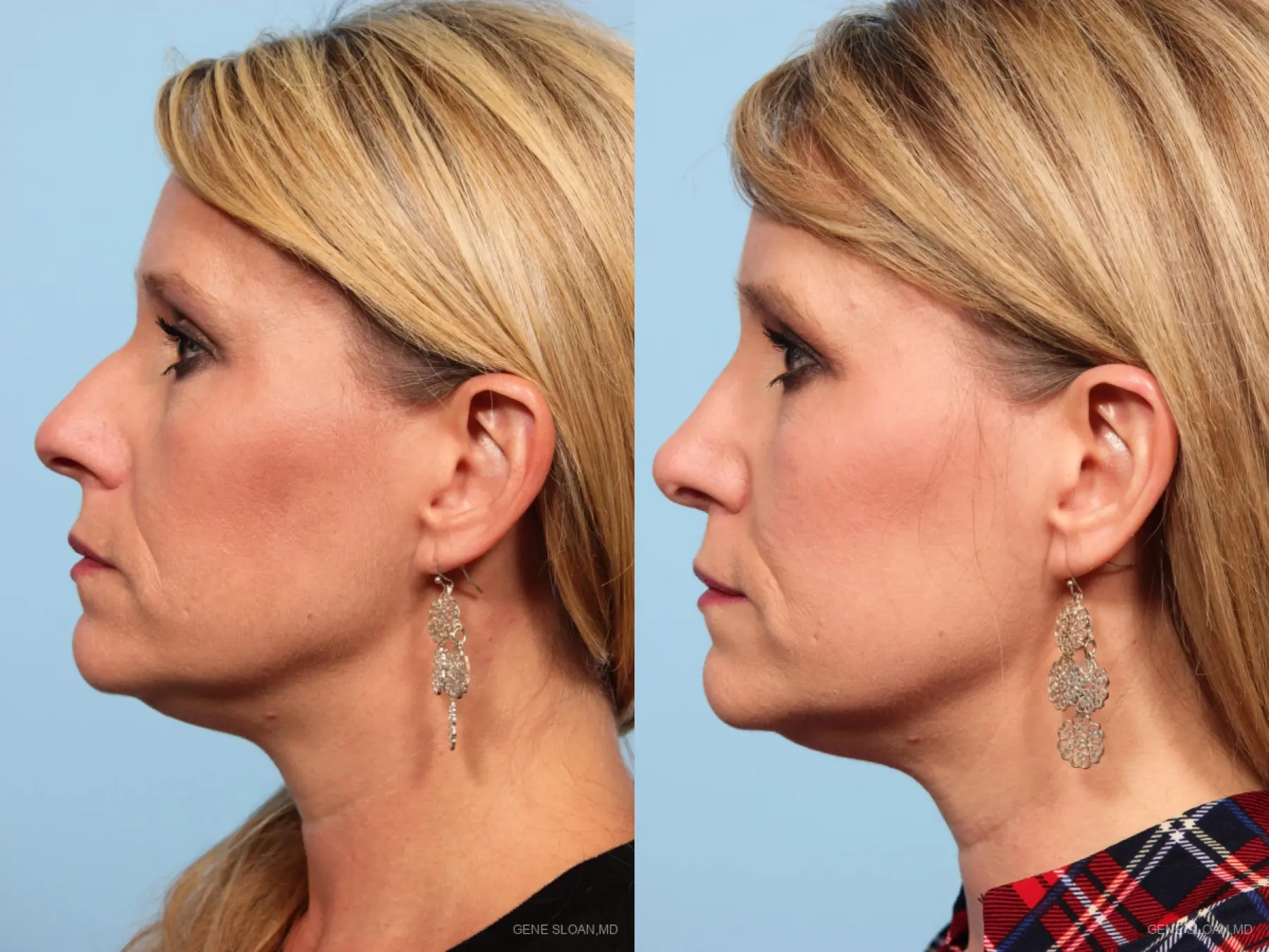 Rhinoplasty: Patient 3 - Before and After 2
