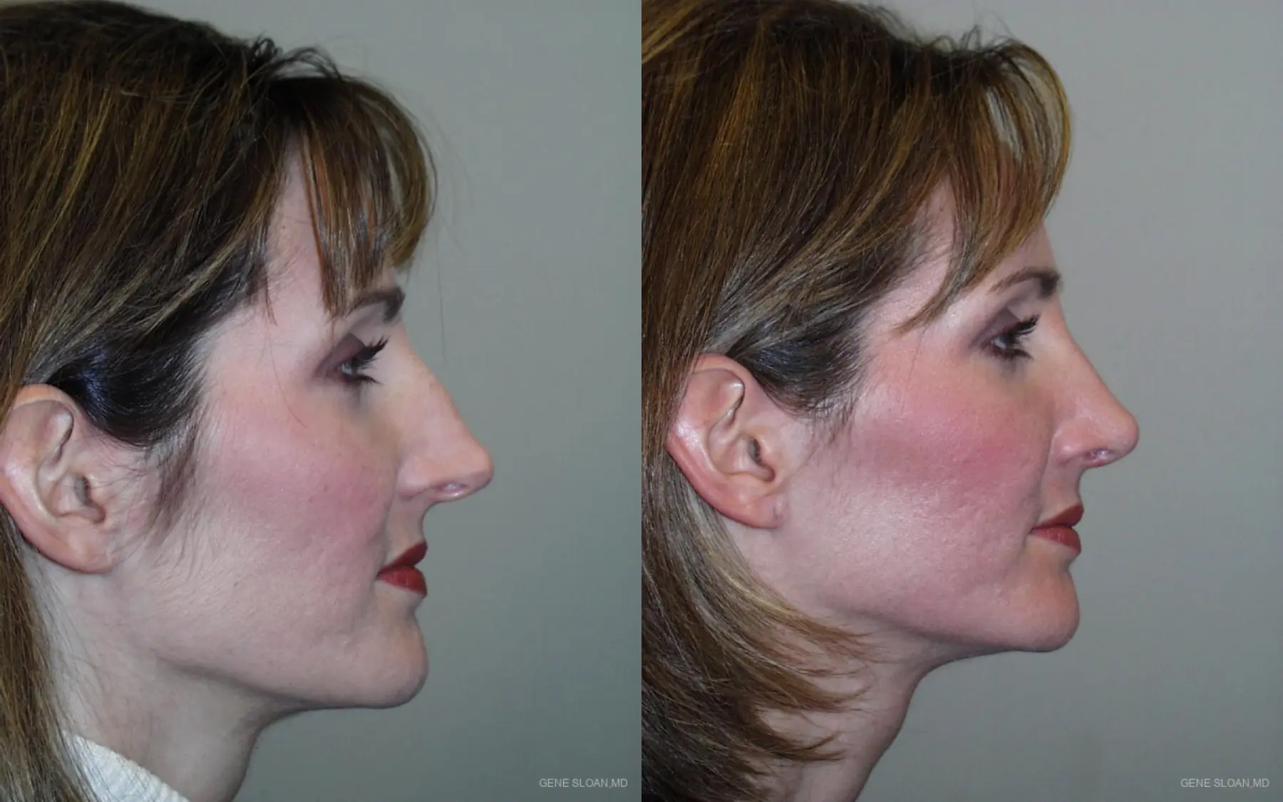 Rhinoplasty: Patient 1 - Before and After 2