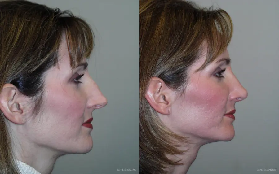 Rhinoplasty: Patient 1 - Before and After 2