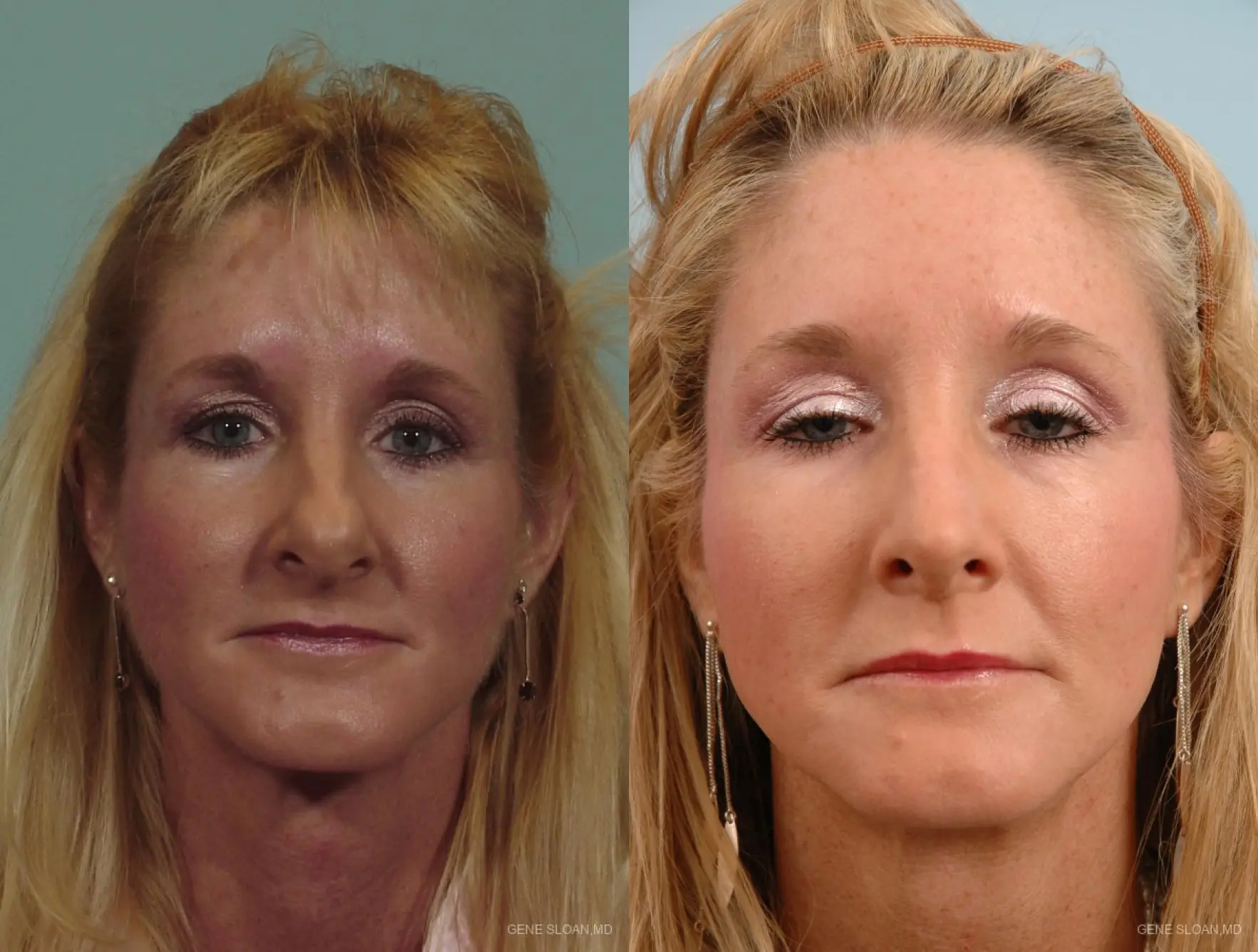 Rhinoplasty: Patient 2 - Before and After