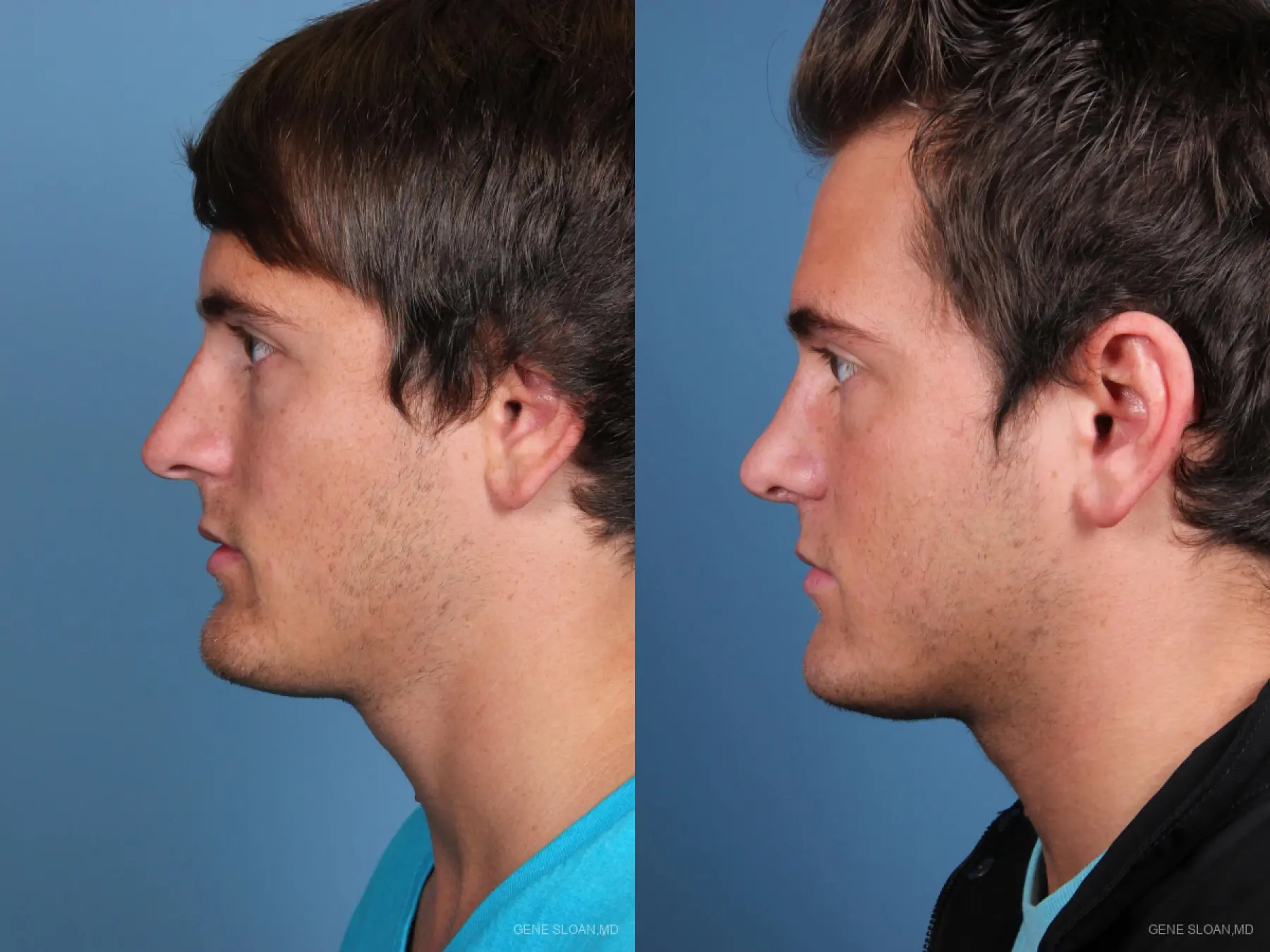 Rhinoplasty: Patient 5 - Before and After 2