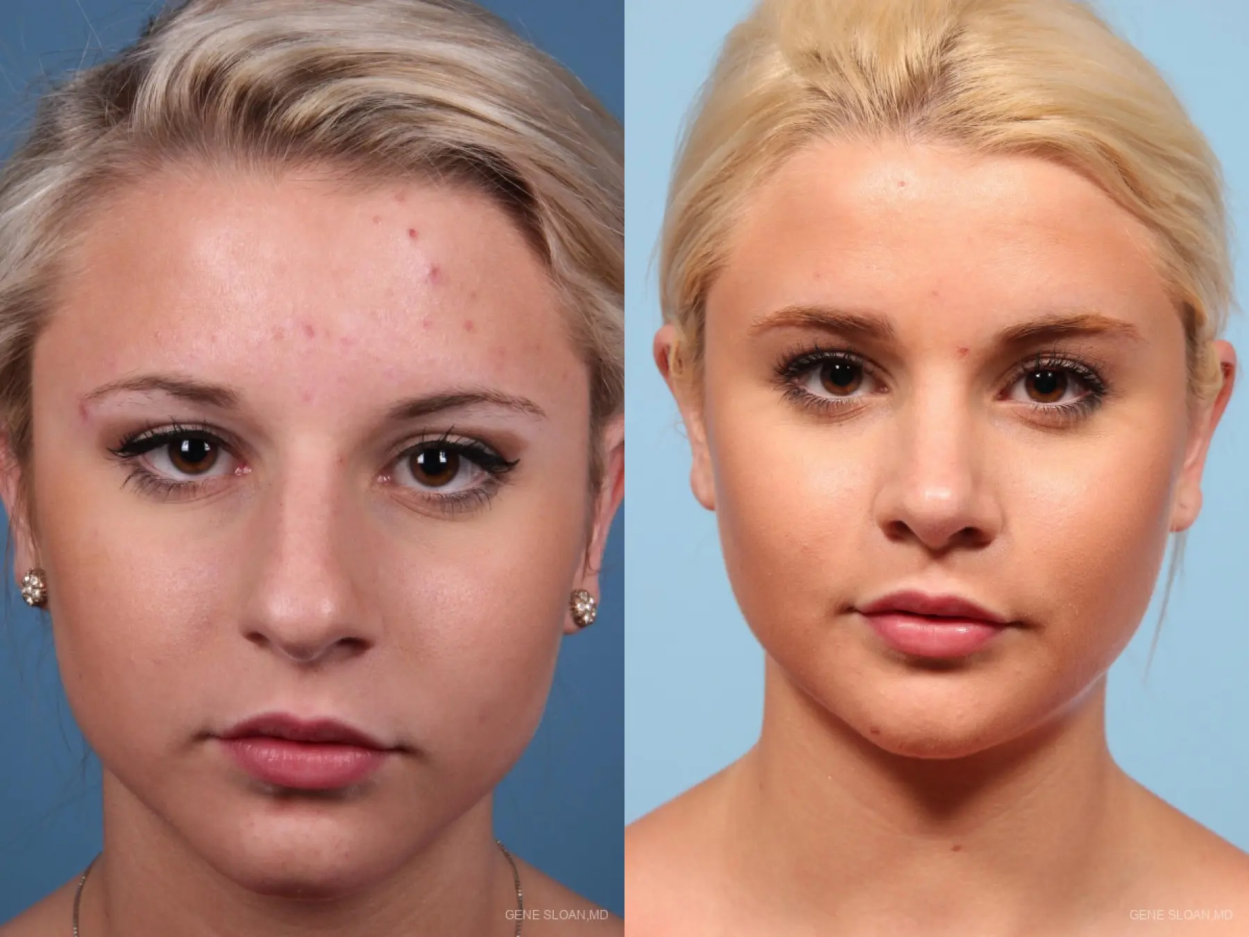Rhinoplasty: Patient 8 - Before and After 1