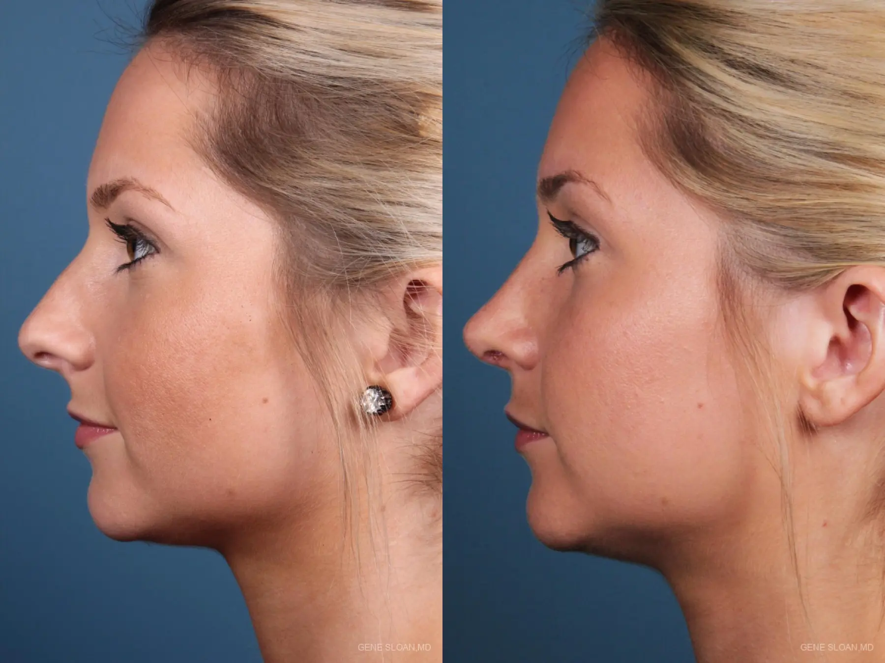 Rhinoplasty: Patient 7 - Before and After 2