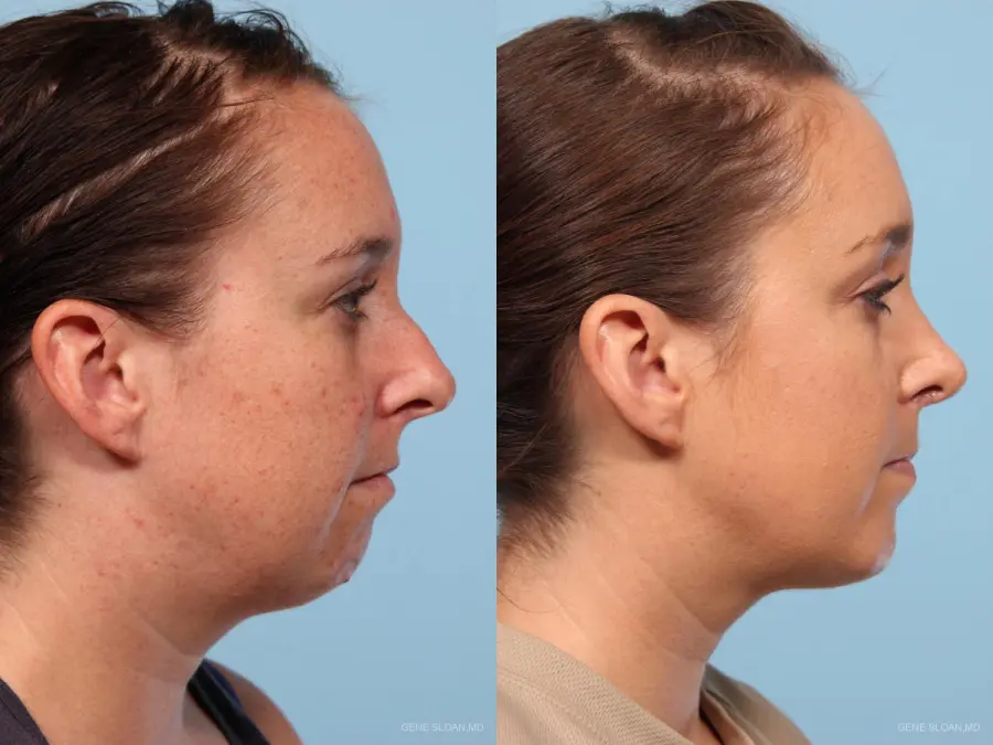 Rhinoplasty: Patient 4 - Before and After 2