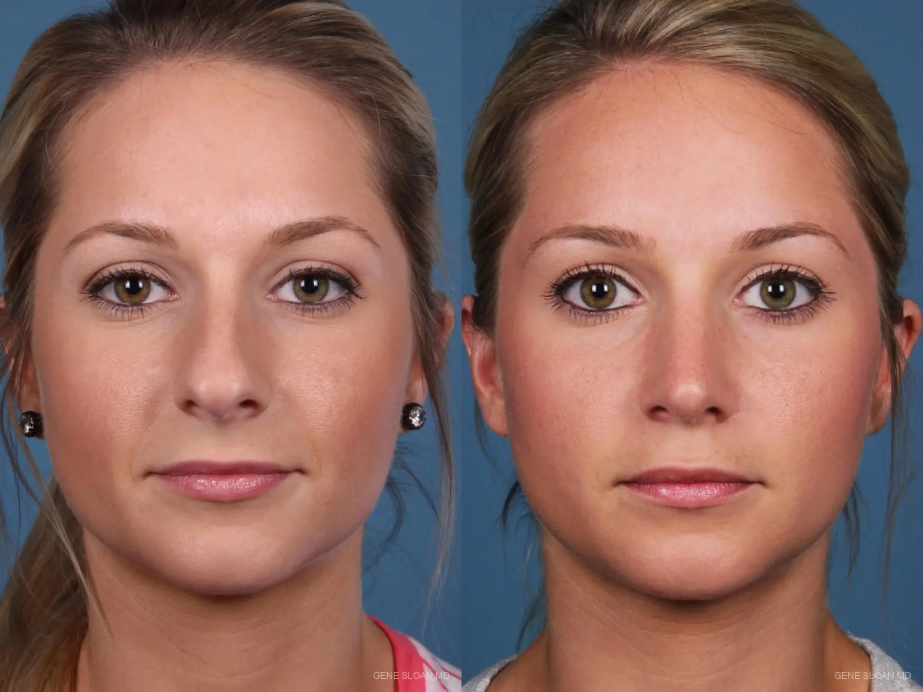 Rhinoplasty: Patient 7 - Before and After
